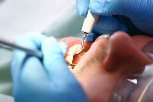 Best Emergency Dental Extractions in Clinton, MD