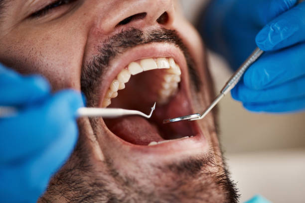 Best Broken or Cracked Tooth Emergency Dentist in Clinton, MD