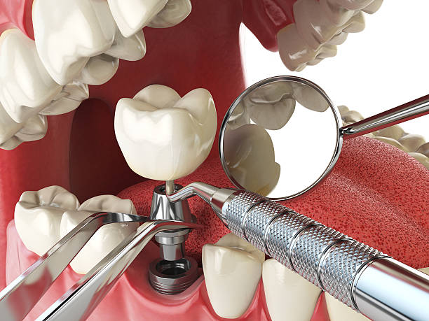 Best Emergency Dental Extractions in Clinton, MD