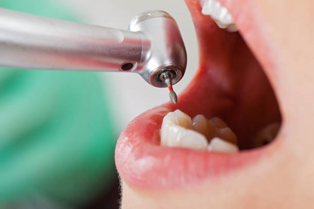 Best Emergency Dentist for Knocked-Out Tooth in Clinton, MD